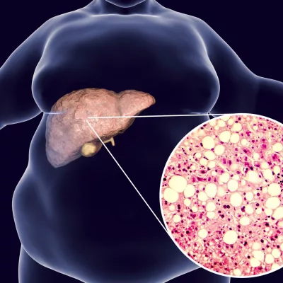Nafld